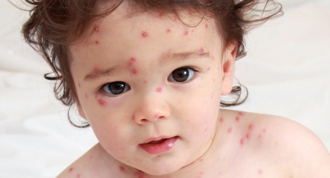 Macam-Macam Alergi Pada Anak Yang Harus Diketahui