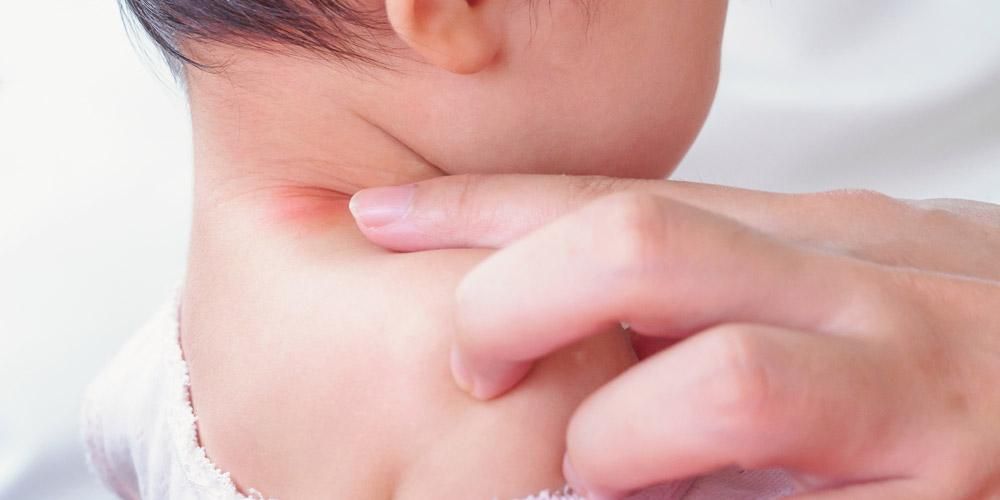 cara menyembuhkan alergi pada anak