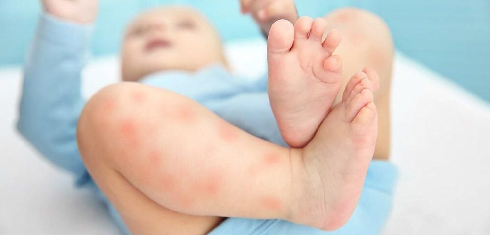 Cara Menyembuhkan Alergi Pada Anak