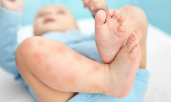 Cara Menyembuhkan Alergi Pada Anak