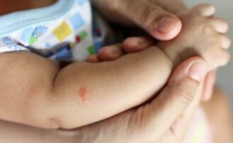 Kenali Hal yang Menyebabkan Rasa Gatal Pada Kulit Bayi