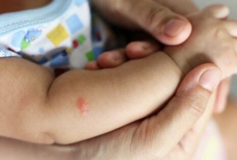 Kenali Hal yang Menyebabkan Rasa Gatal Pada Kulit Bayi