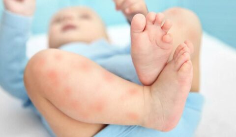 cara menyembuhkan alergi pada anak