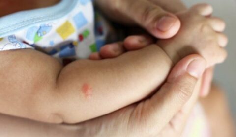 Gatal Pada Kulit Bayi